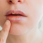 L'herpes labiale si contrasta intervenendo ai primissimi sintomi: creme antivirali da banco, cerotti idrocolloidali e stick labbra con protezione solare sarebbero gli alleati più utili.